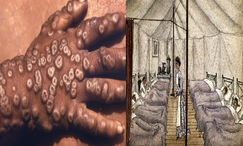 உலக அளவில் பெரியம்மை நோய் ஒழிக்கப்பட்டுள்ளதாக உலக சுகாதார நிறுவனம் அறிவித்த தினம் இன்று