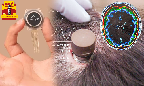 சிப் பொருத்தப்பட்ட நபரின் நிலைமை என்ன ?.. வெற்றியை நோக்கி நகர்கிறதா நியூராலிங்கின் சோதனை ?