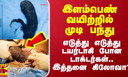 இளம்பெண் வயிற்றில் 1.5 கிலோ கருகரு உருண்டை.. என்னவென்று தெரிந்ததும் திகிலடித்த டாக்டர்கள்