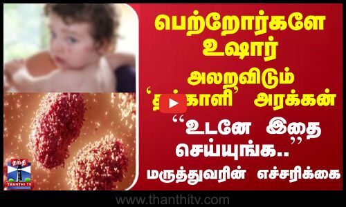 பெற்றோர்களே உஷார்... அலறவிடும் `தக்காளி அரக்கன்... உடனே இதை செய்யுங்க மருத்துவரின் எச்சரிக்கை