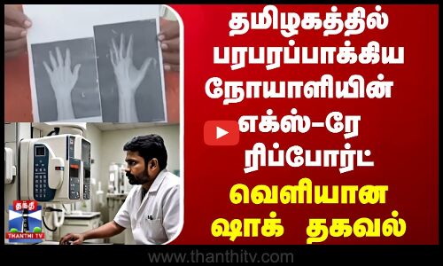 தமிழகத்தில் பரபரப்பாக்கிய நோயாளியின் எக்ஸ்-ரே ரிப்போர்ட்.. வெளியான ஷாக் தகவல்