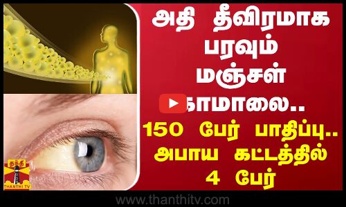 அதி தீவிரமாக பரவும் மஞ்சள் காமாலை.. 150 பேர் பாதிப்பு.. அபாய கட்டத்தில் 4 பேர்