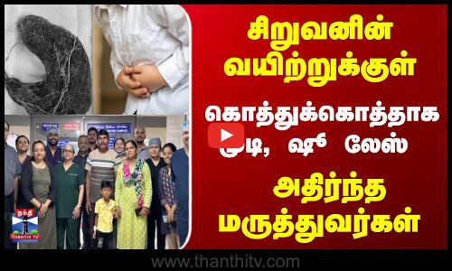 Child | Operation | சிறுவனின் வயிற்றுக்குள் கொத்துக்கொத்தாக முடி, ஷூ லேஸ் - அதிர்ந்த மருத்துவர்கள்