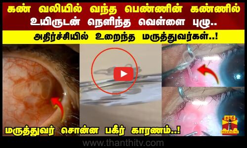 கண் வலியில் வந்த பெண்ணின் கண்ணில்  உயிருடன் நெளிந்த வெள்ளை புழு