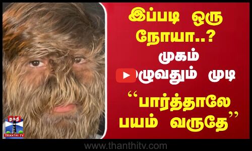 இப்படி ஒரு நோயா..? முகம் முழுவதும் முடி பார்த்தாலே பயம் வருதே