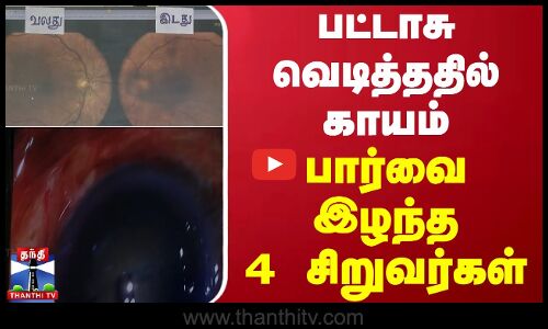 பட்டாசு வெடித்ததில் காயம் - பார்வை இழந்த 4 சிறுவர்கள் | Vision Lost