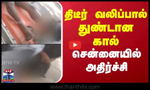 Chennai | Seizure | திடீர் வலிப்பால் துண்டான கால் - சென்னையில் அதிர்ச்சி