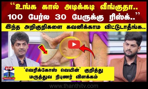 Doctor Time | Varicose Veins | உங்க கால் அடிக்கடி வீங்குதா.. 100 பேர்ல 30 பேருக்கு ரிஸ்க்..