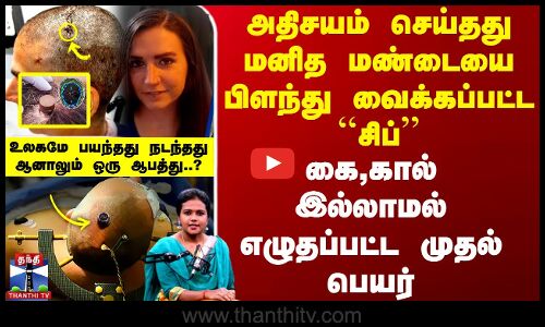 அதிசயம் செய்தது மனித மண்டையை பிளந்து வைக்கப்பட்ட ``சிப்